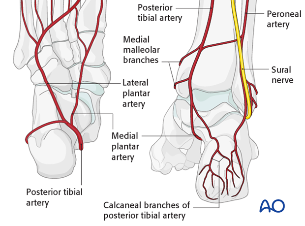 extended lateral approach to the calcaneus