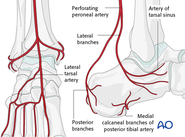 extended lateral approach to the calcaneus