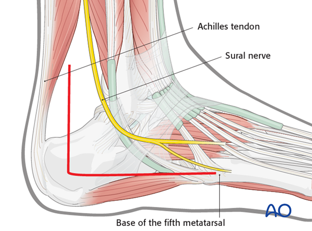 extended lateral approach to the calcaneus