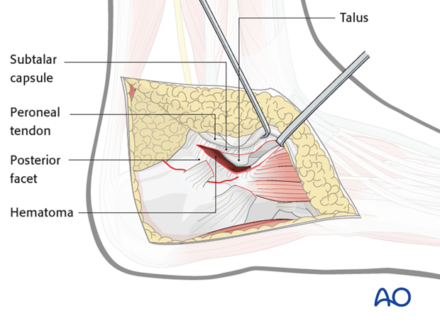 extended lateral approach to the calcaneus