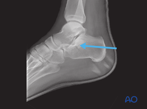 medial approach to the calcaneus