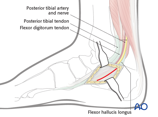 medial approach to the calcaneus