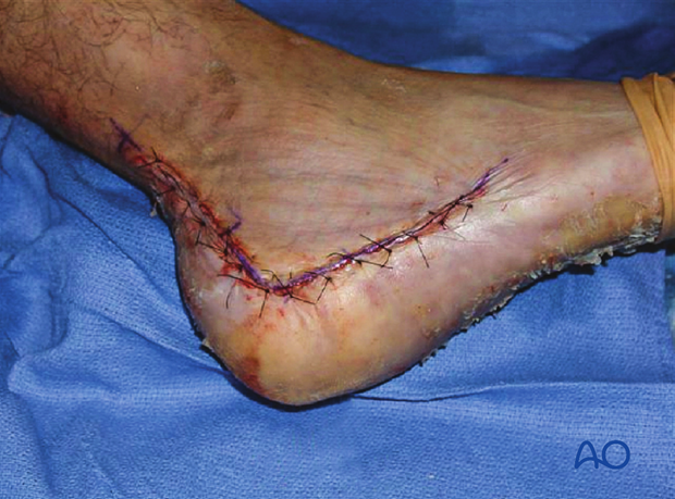 extended lateral approach to the calcaneus