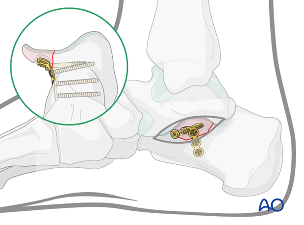 sustentacular fractures