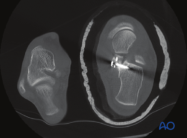 orif screw fixation