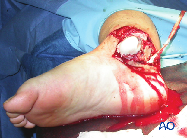 combined hindfoot injuries