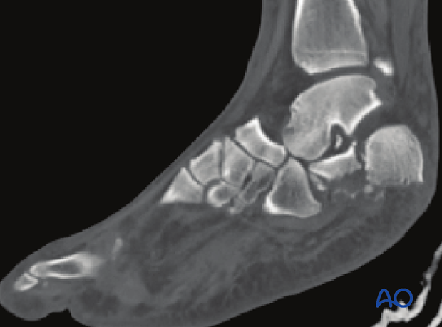 combined hindfoot injuries