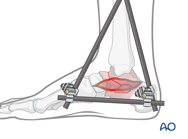 combined hindfoot injuries