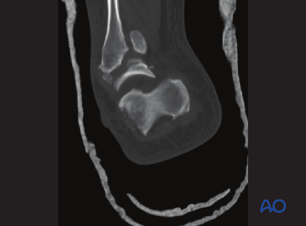 combined hindfoot injuries