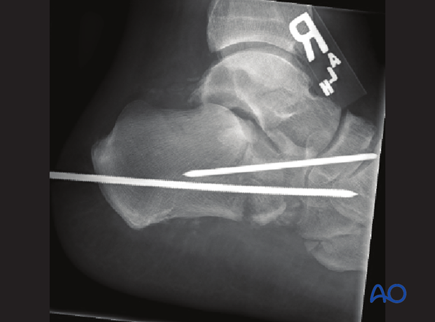 combined hindfoot injuries