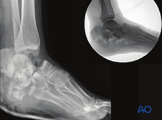 Severe open hindfoot injury