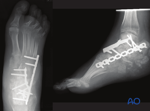 combined hindfoot injuries