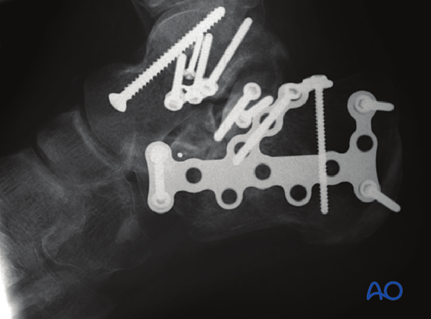 combined hindfoot injuries