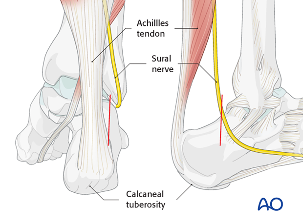 mio posterior approach to the calcaneus