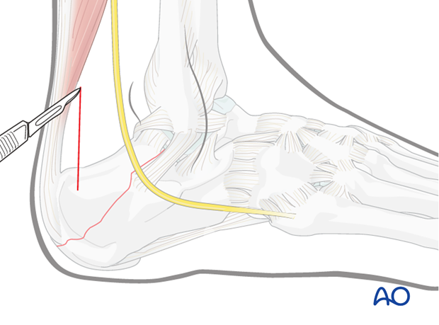 mio posterior approach to the calcaneus