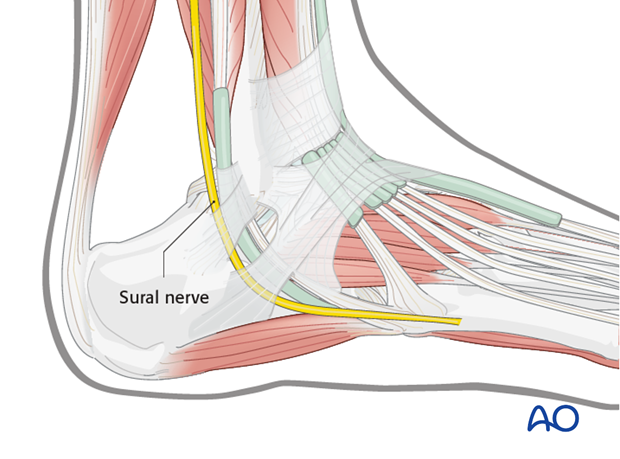 sinus tarsi approach to the calcaneus