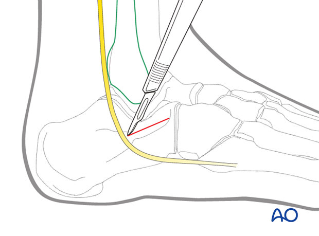 sinus tarsi approach to the calcaneus