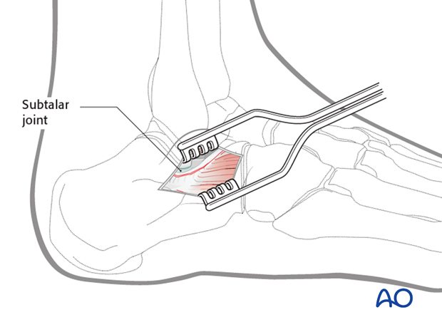 sinus tarsi approach to the calcaneus