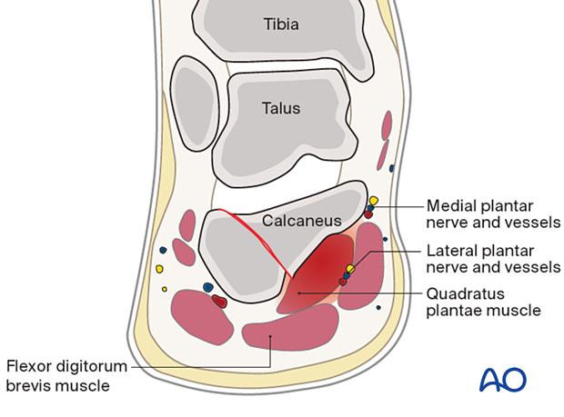 Bleeding into the calcaneal compartment of the foot due to calcaneal fracture