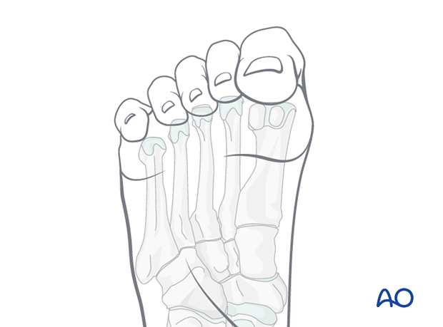 Toe contractures in the foot