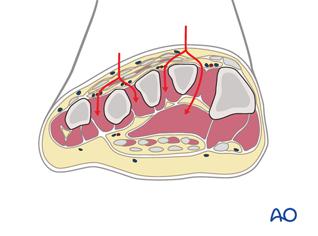 Deep dissection of double-dorsal incision to treat foot compartment syndrome