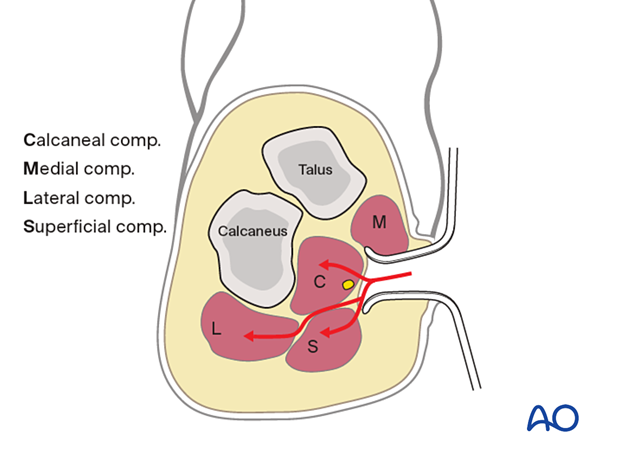 Deep dissection of medial incision to treat foot compartment syndrome