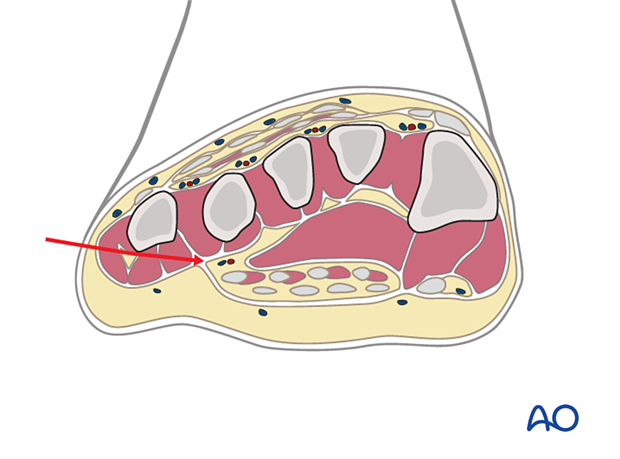 Deep dissection of lateral incision to treat foot compartment syndrome