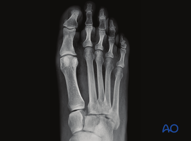 Malalignment at the medial border of intermediate cuneiform and the 2nd metatarsal