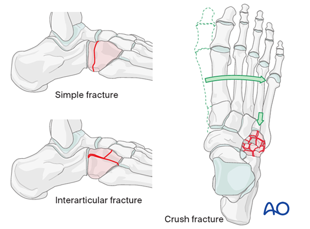 Fractures addressed with the dorsolateral approach to the cuboid