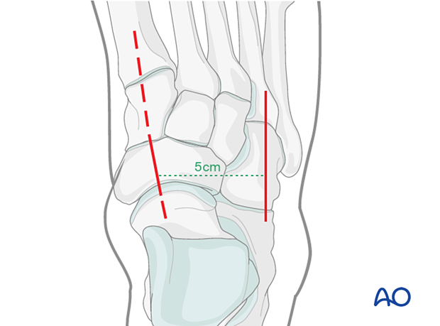 Combination of the dorsomedial approach with the dorsolateral approach to the cuboid