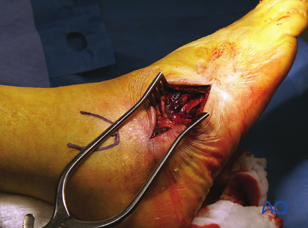 Skin incision for a dorsolateral approach to the cuboid