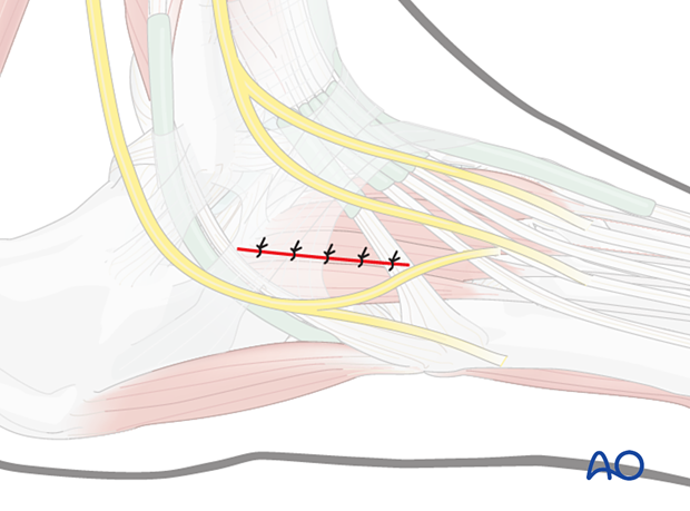 Wound closure for the dorsolateral approach to the cuboid