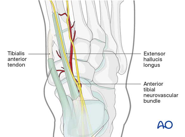 Critical anatomical structures encountered in a dorsomedial approach to the navicular