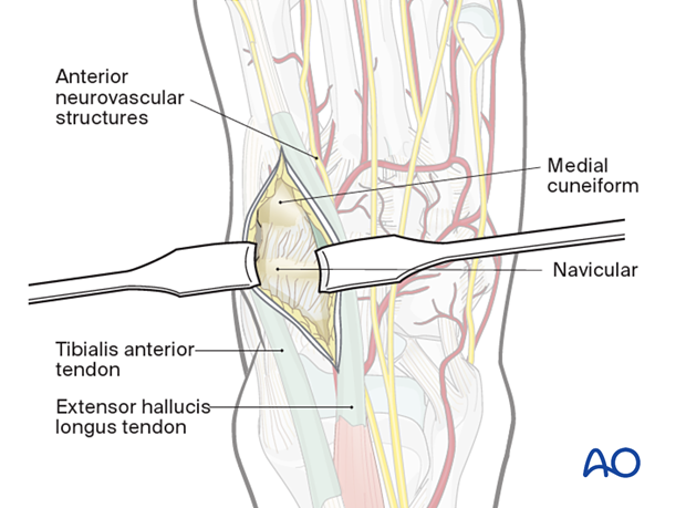 Exposure of navicular and medial cuneiform with a dorsomedial approach