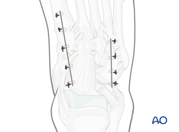 Wound closure in a dorsomedial approach to the navicular