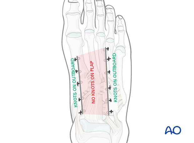 Wound closure for the percutaneous approach to the navicular