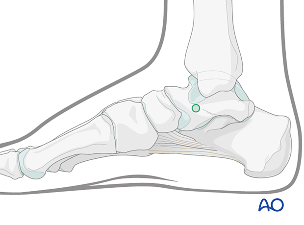 Medial safe zone for pins and K-wires insertion in the talar neck