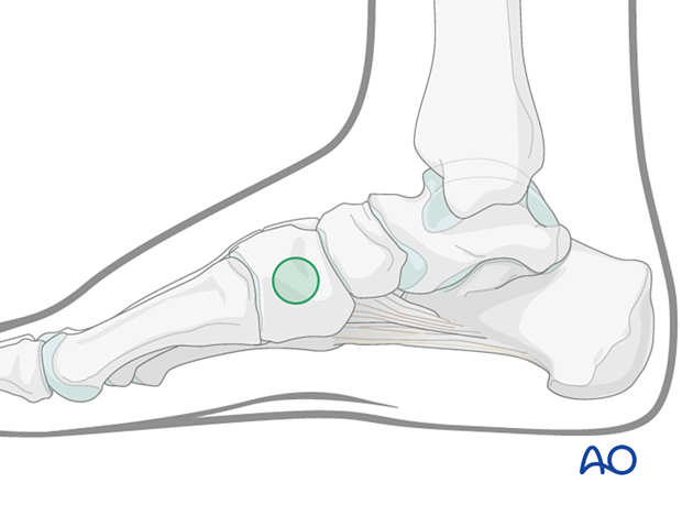 Medial safe zone for pins and K-wires insertion in the cuneiform