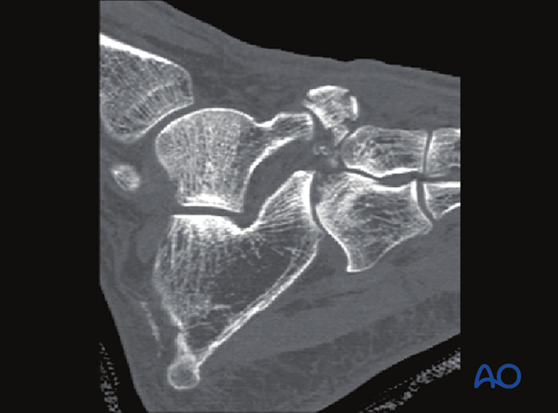 CT image of a Chopart injury