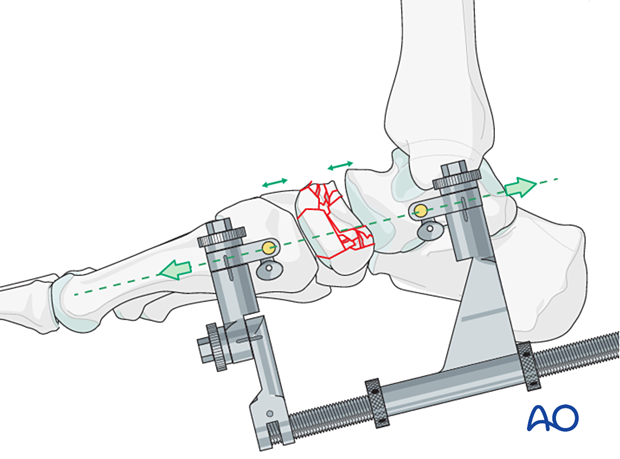 Application of distraction with a medial-column distractor for reduction of a multifragmentary articular navicular fracture