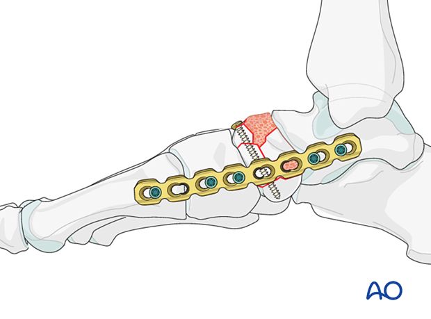 Temporary bridging of talonavicular joint