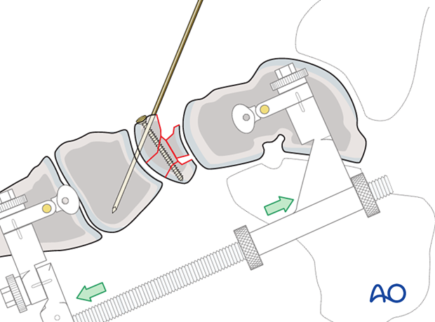 Restoration of medial column length for Temporary bridging of talonavicular joint