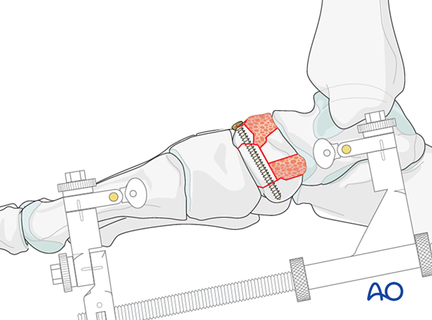 Addition of bone graft to the navicular