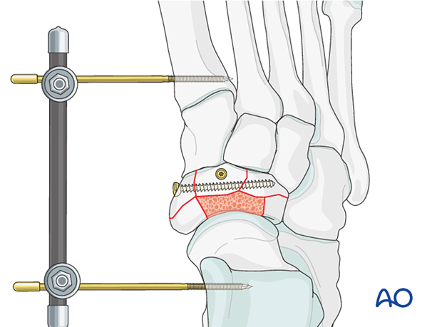 Temporary bridging using an external fixator of the talonavicular joint