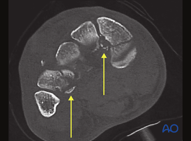 Avulsion fractures of the proximal second to fourth metatarsals