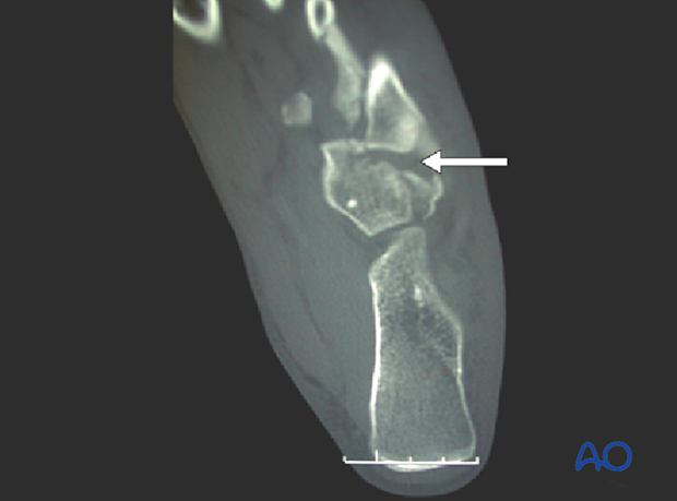 CT scan of nutcracker injury.