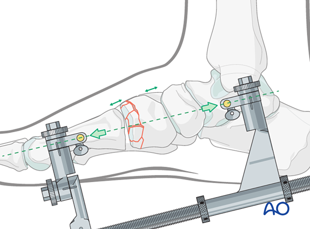 Application of distraction with a medial-column distractor for reduction of a multifragmentary cuneiform fracture