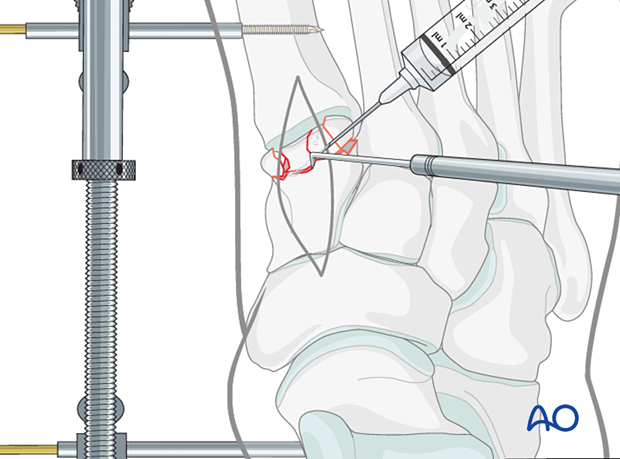 Irrigation of a multifragmentary articular cuneiform fracture