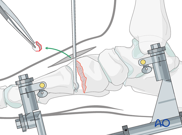 Removal of the proximal cartilage of the first metatarsal with a curette