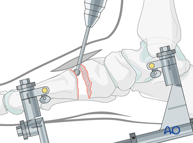 Preparation of the first tarsometatarsal joint for fusion